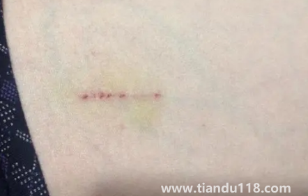 被猫抓了一下轻微破皮要打针吗（被猫抓伤多少天过危险期）