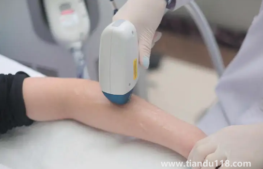 冰点脱毛的具体价格是多少钱（冰点脱毛一次能维持多久）