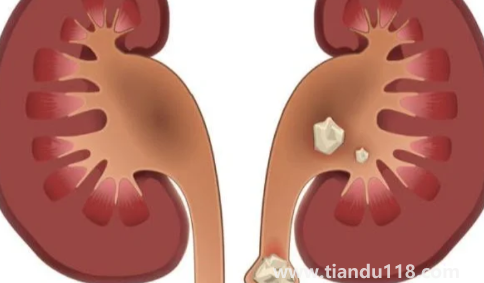 肾结石3mm×3mm多大2